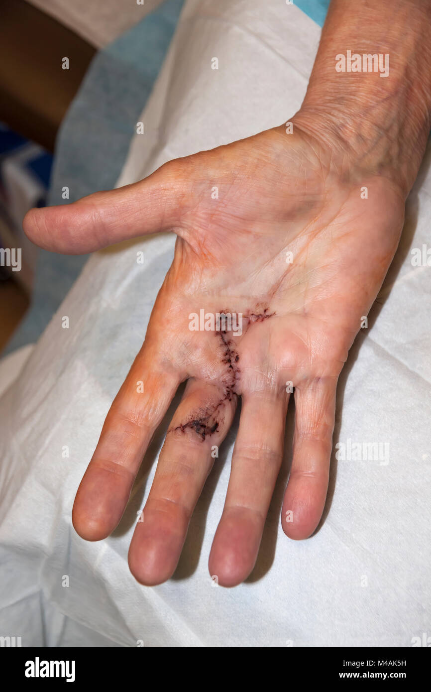 Woman's hand with stitches just removed one month after Dupuytren's Contracture surgery,to correct her finger and palm. Stock Photo