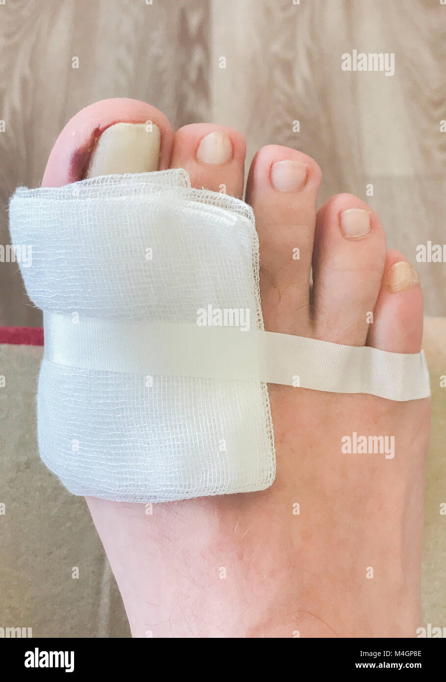 Toe operation on the big toe in the hospital Stock Photo