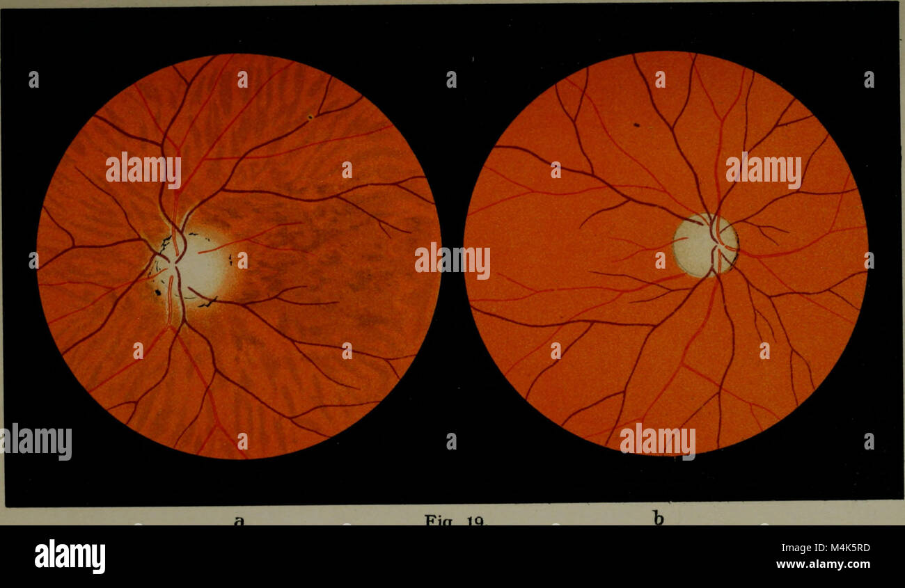 Atlas and epitome of ophthalmoscopy and ophthalmoscopic diagnosis (1910