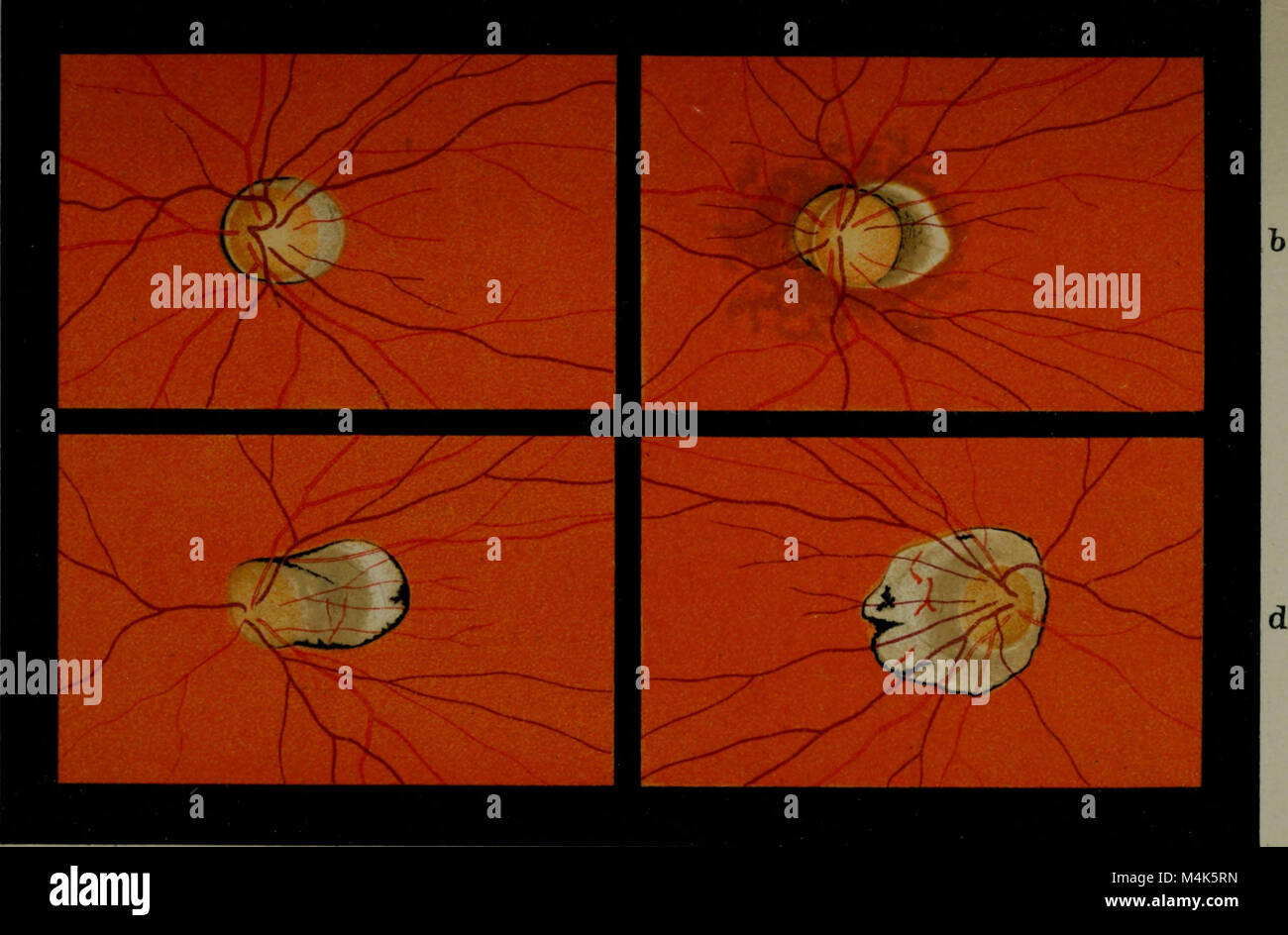 Atlas and epitome of ophthalmoscopy and ophthalmoscopic diagnosis (1910
