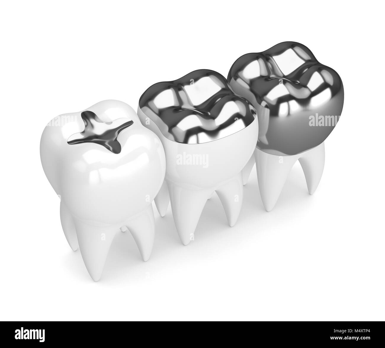 3d render of teeth with inlay, onlay and crown amalgam filling over