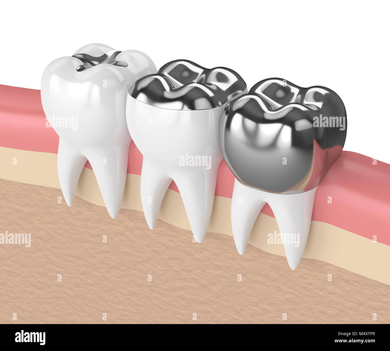 3d render of teeth with inlay, onlay and crown amalgam filling in Stock