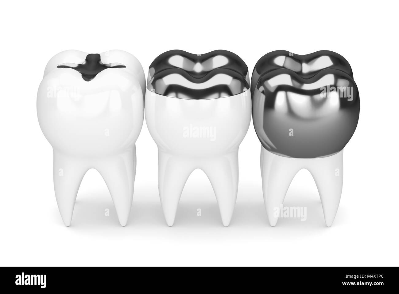 3d render of teeth with inlay, onlay and crown amalgam filling over white background Stock Photo