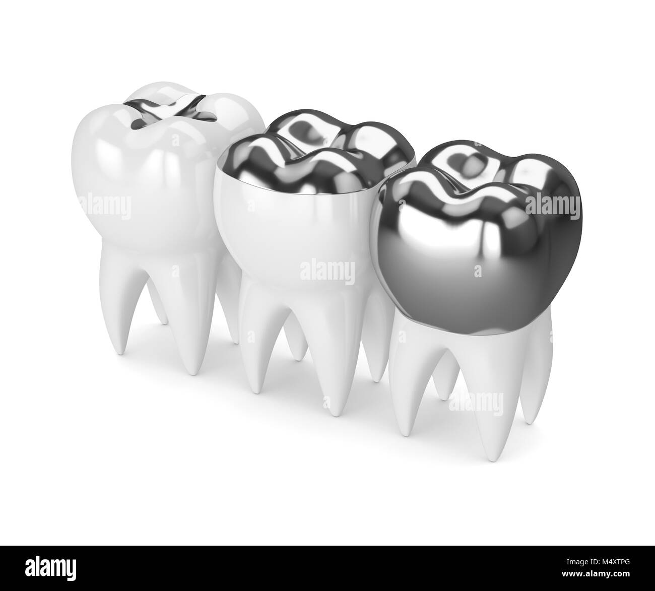 3d render of teeth with inlay, onlay and crown amalgam filling over white background Stock Photo