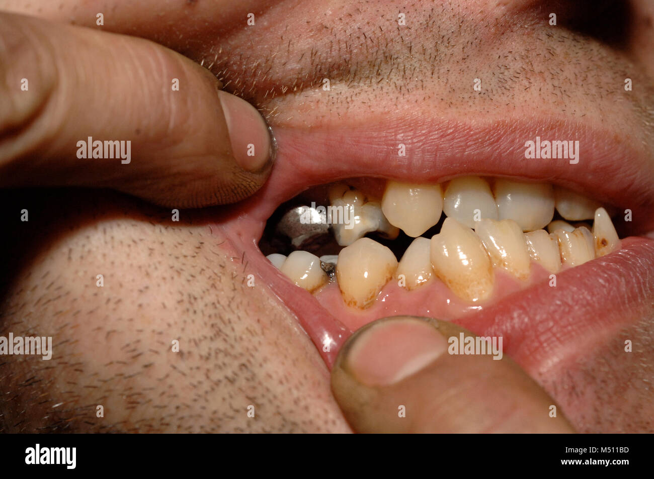 Uneven teeth hires stock photography and images Alamy