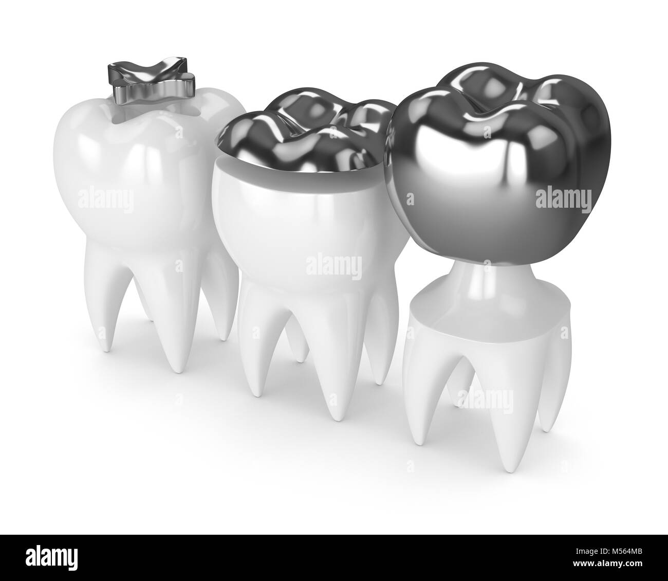 3d render of teeth with inlay, onlay and crown amalgam filling over white background Stock Photo