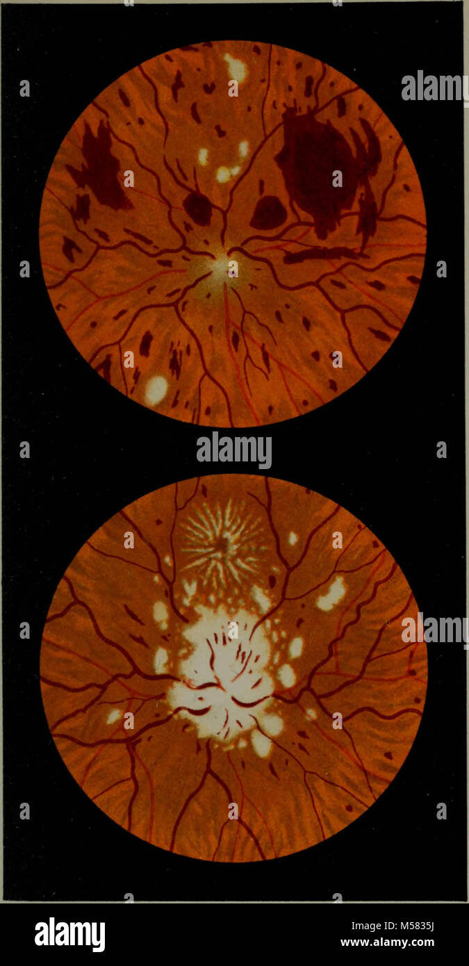 "Atlas and epitome of ophthalmoscopy and ophthalmoscopic diagnosis