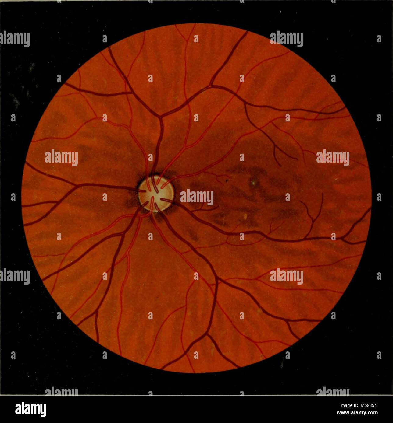 "Atlas and epitome of ophthalmoscopy and ophthalmoscopic diagnosis