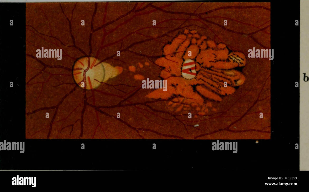 "Atlas and epitome of ophthalmoscopy and ophthalmoscopic diagnosis