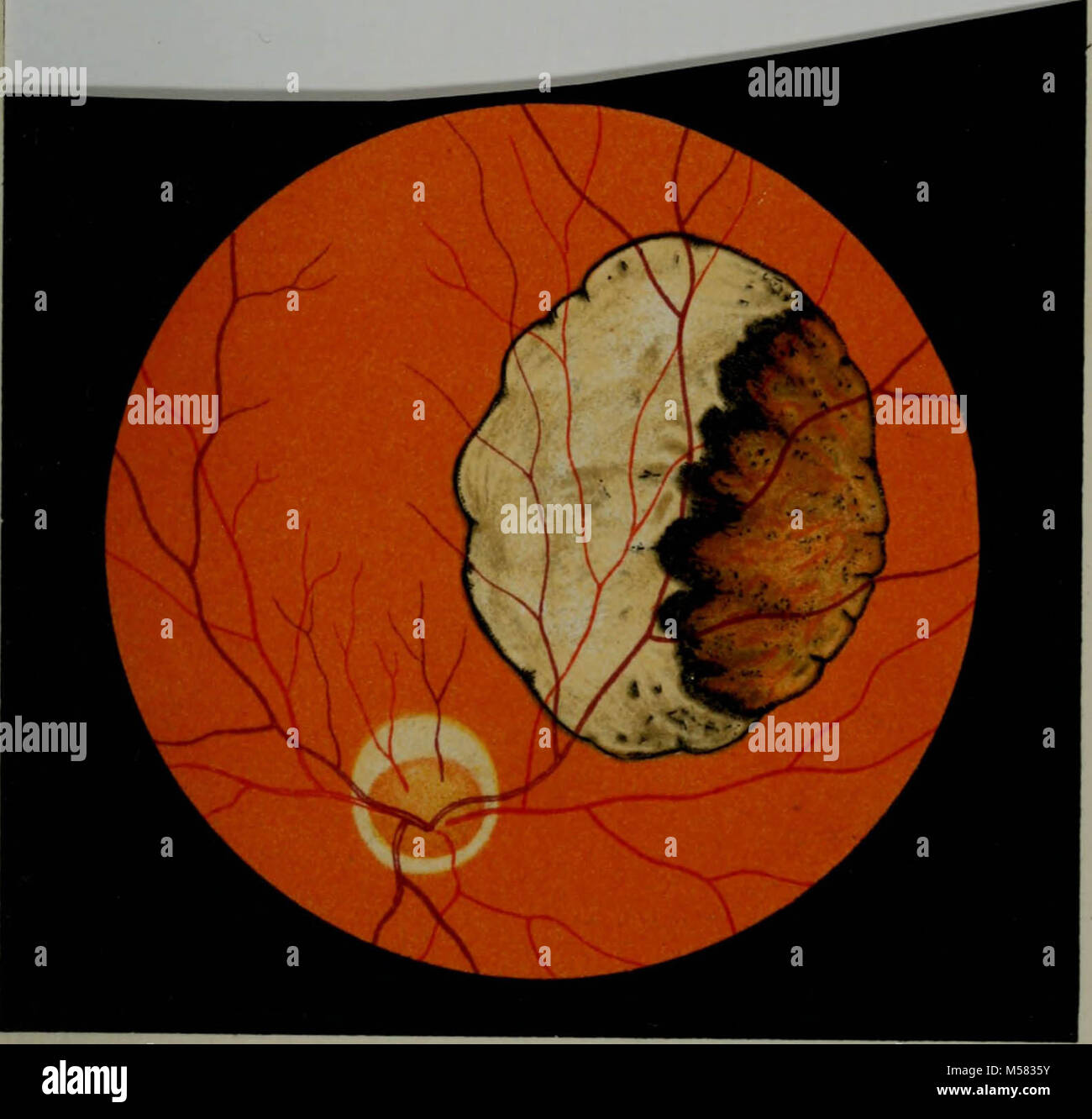 "Atlas and epitome of ophthalmoscopy and ophthalmoscopic diagnosis