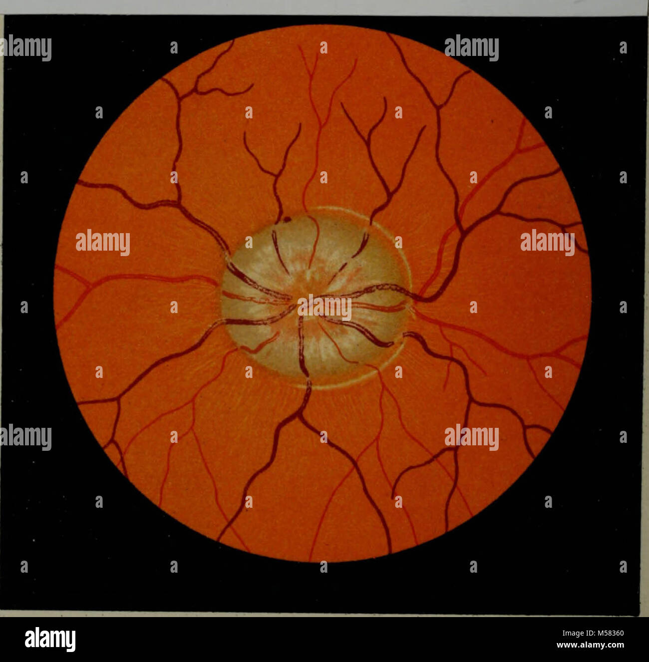 "Atlas and epitome of ophthalmoscopy and ophthalmoscopic diagnosis