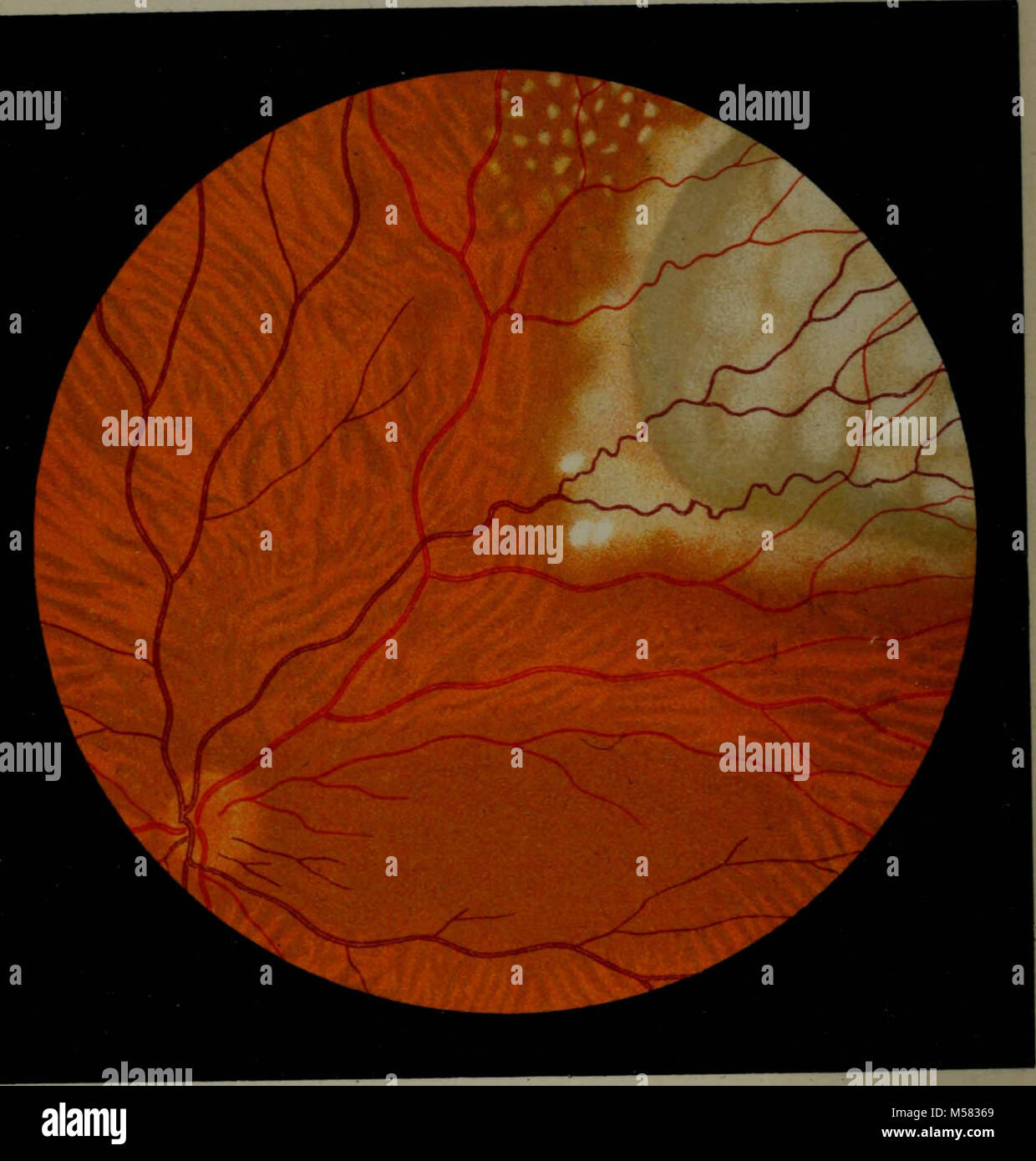 "Atlas and epitome of ophthalmoscopy and ophthalmoscopic diagnosis