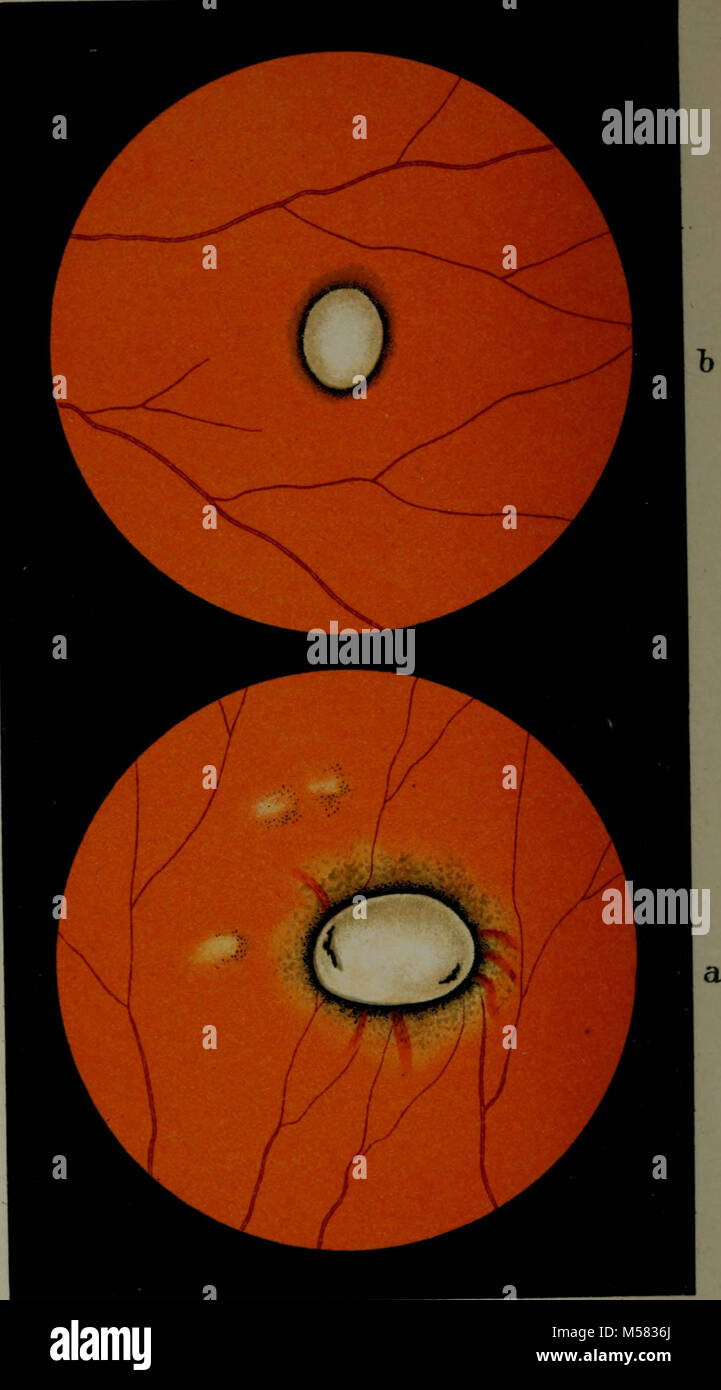 "Atlas and epitome of ophthalmoscopy and ophthalmoscopic diagnosis