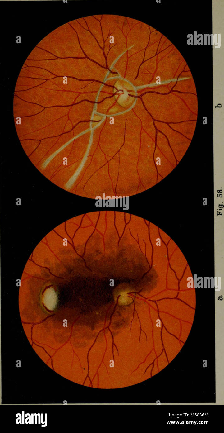 "Atlas and epitome of ophthalmoscopy and ophthalmoscopic diagnosis
