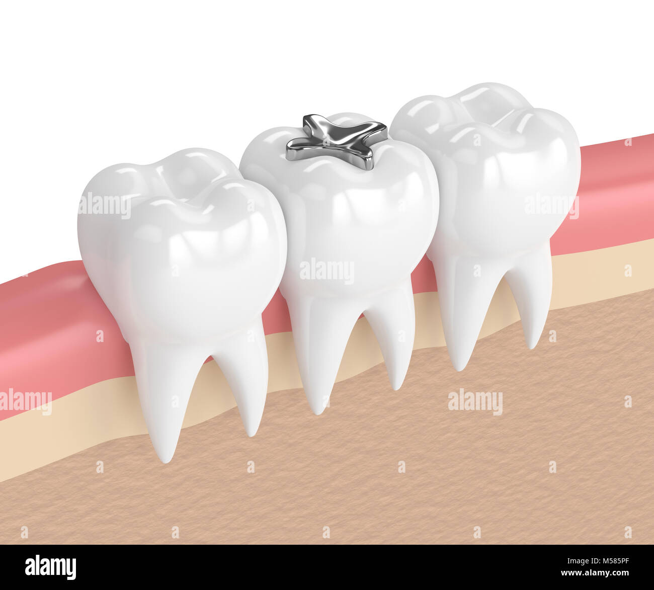 Amalgam filling teeth hires stock photography and images Alamy
