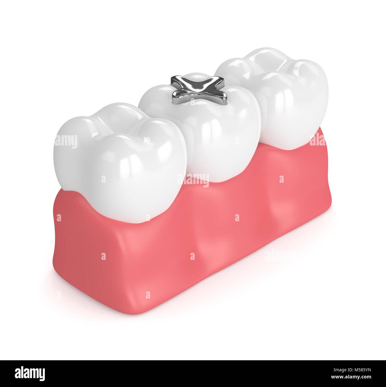 Amalgam filling Cut Out Stock Images & Pictures Alamy