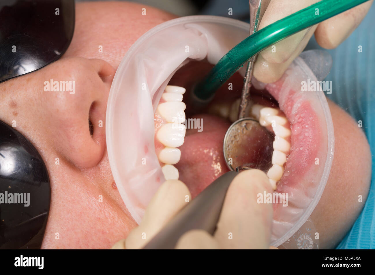 Girl patient with protection glasses with dental braces and mouth retractor during treatment at dentist office with dentist and assistant with saliva ejector and dental mirror dentist tools side view Stock Photo