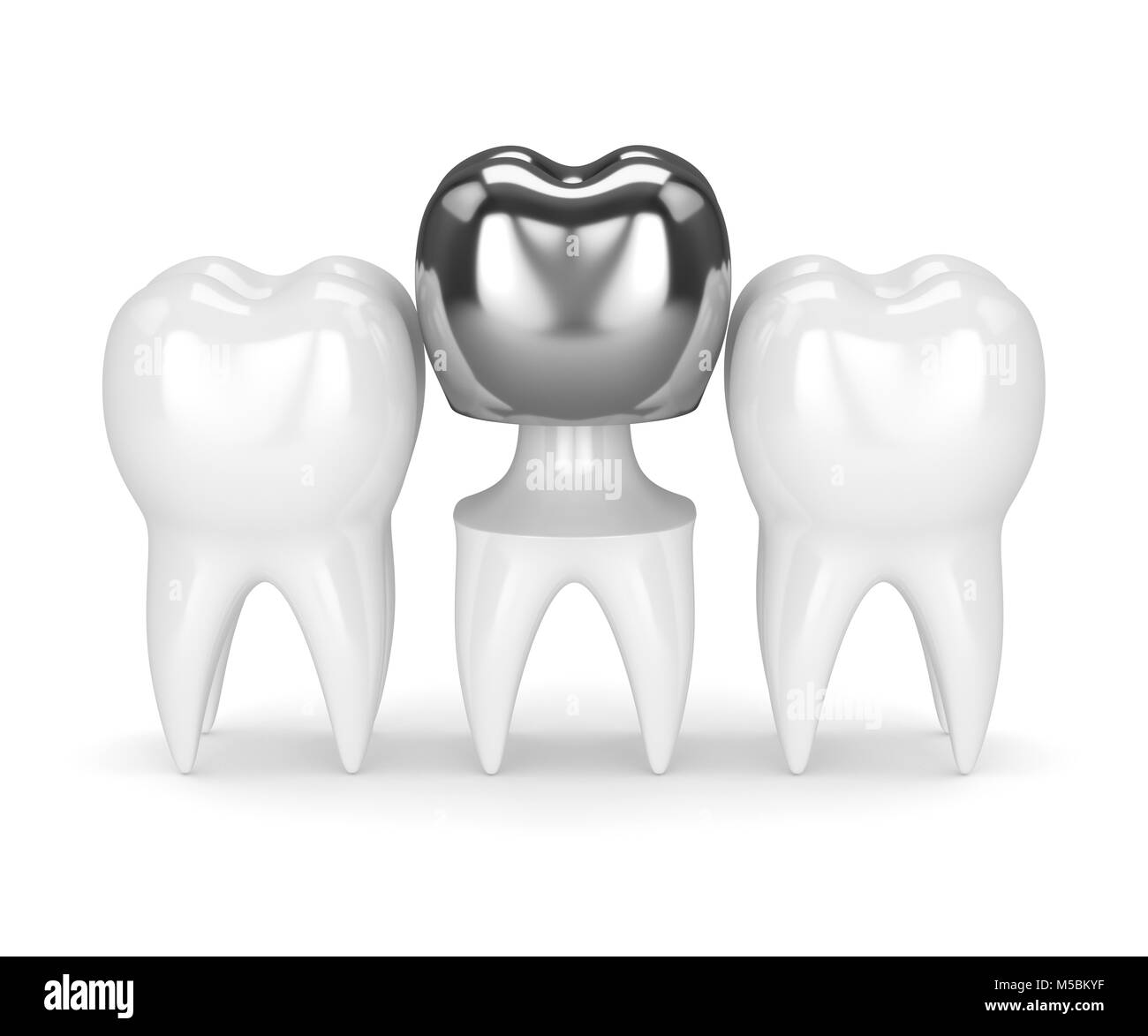 3d render of teeth with dental crown amalgam filling over white
