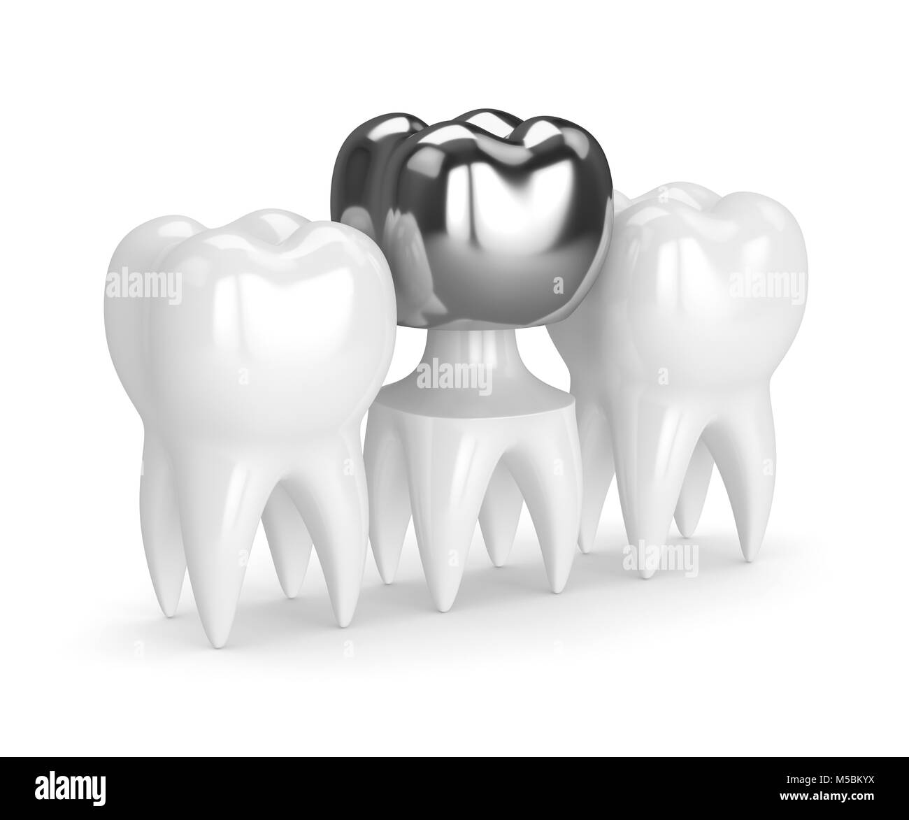 3d render of teeth with dental crown amalgam filling over white