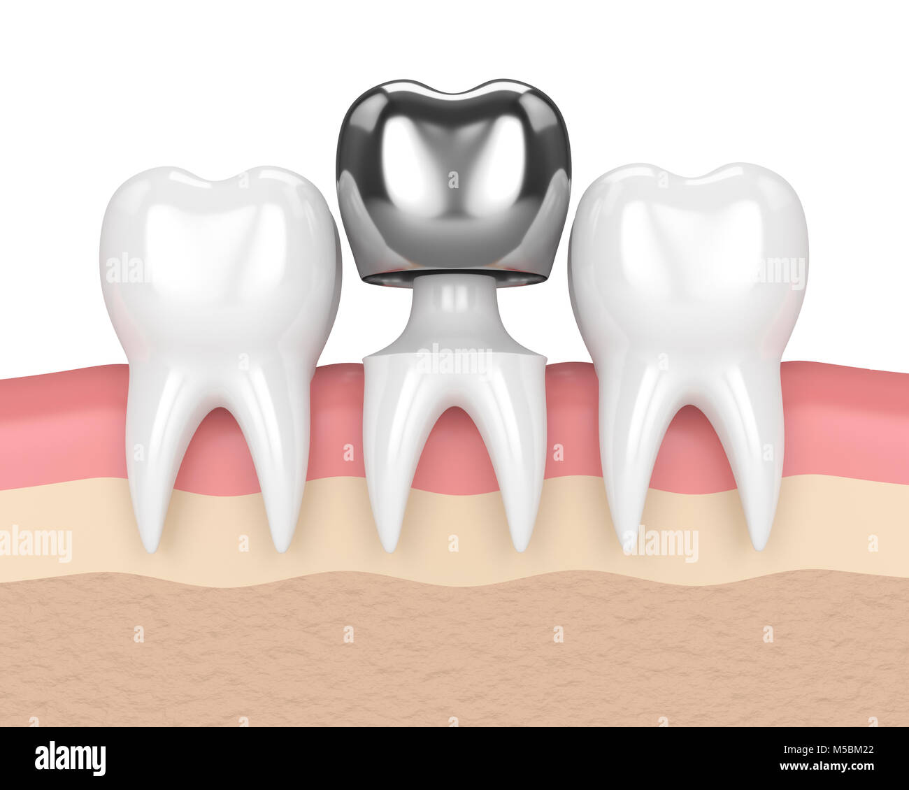 3d render of teeth with dental crown amalgam filling in gums Stock Photo Alamy