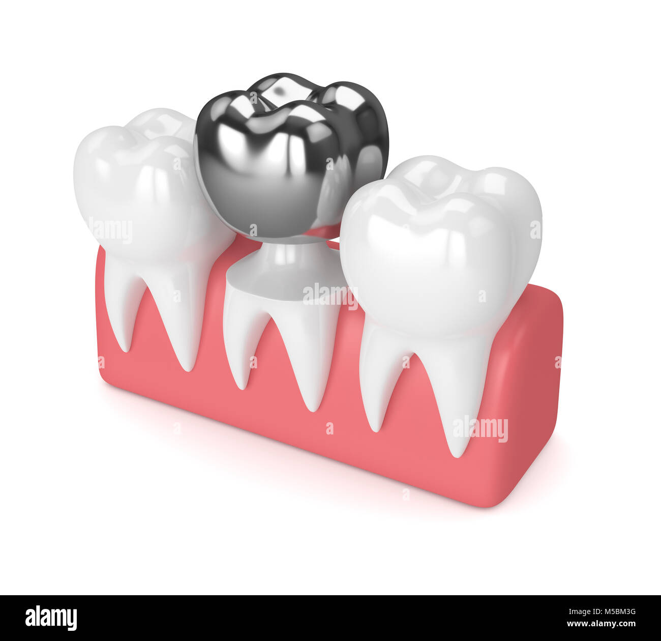 3d render of teeth with dental crown amalgam filling in gums over white