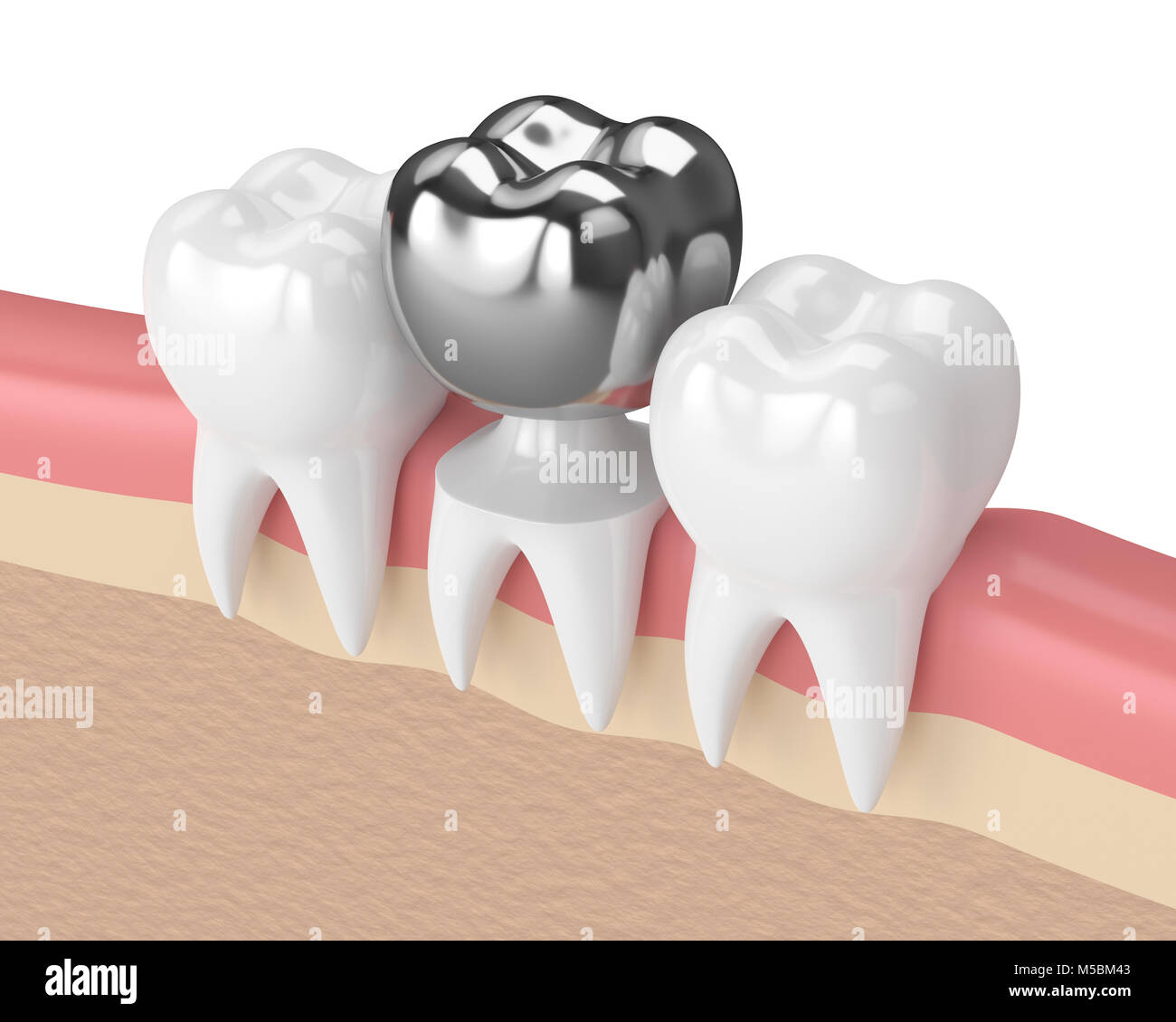Amalgam Filling High Resolution Stock Photography and Images Alamy