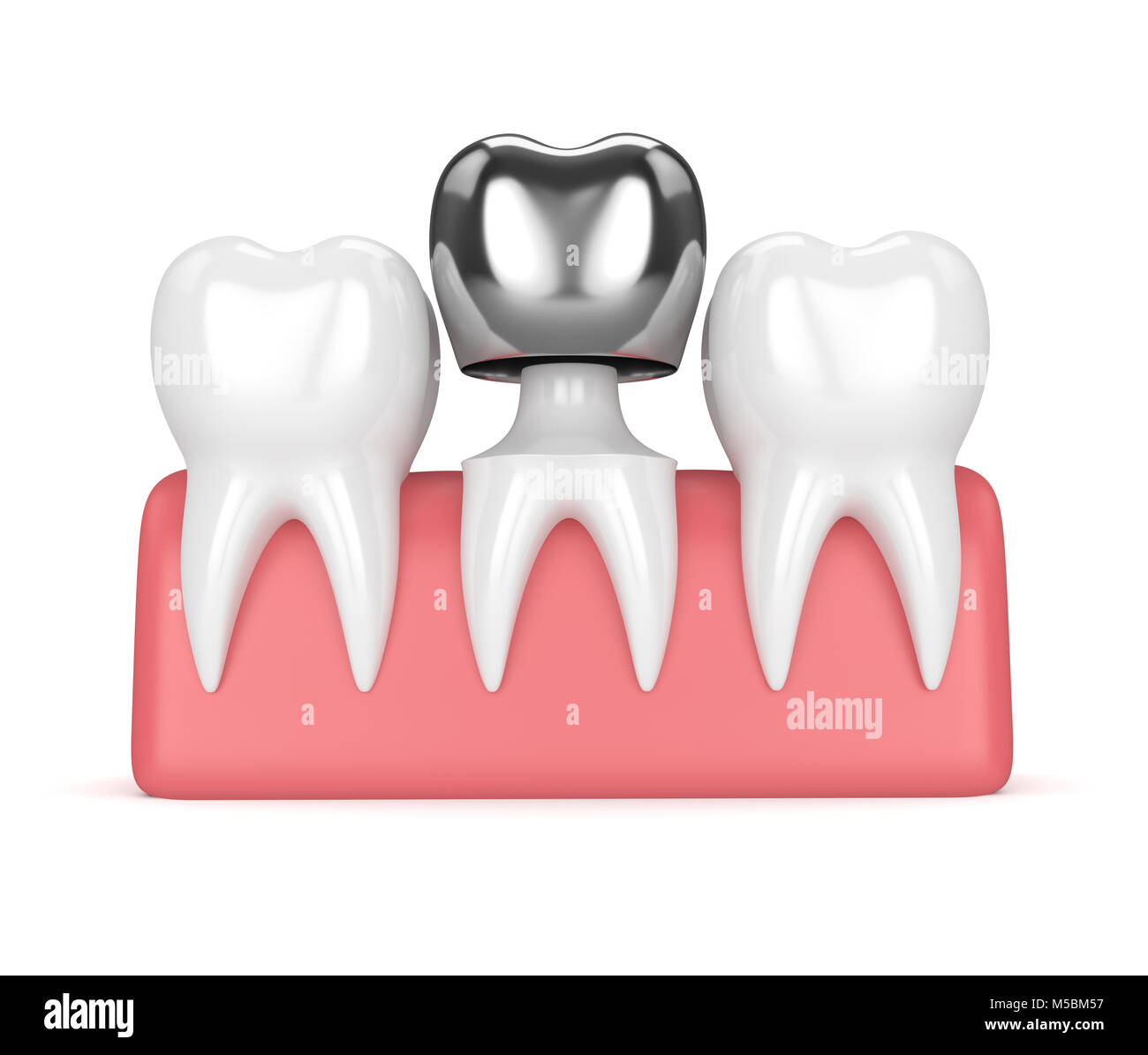3d render of teeth with dental crown amalgam filling in gums over white