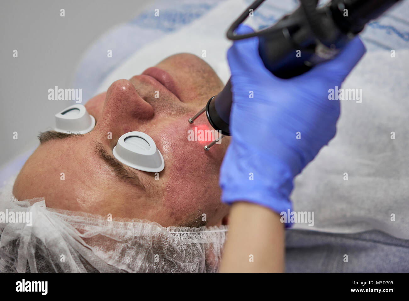 laser polishing of male face skin Stock Photo Alamy