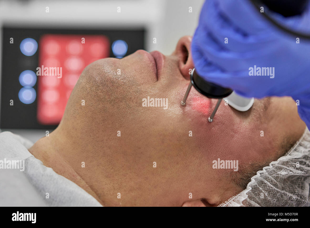 laser polishing of male face skin Stock Photo Alamy