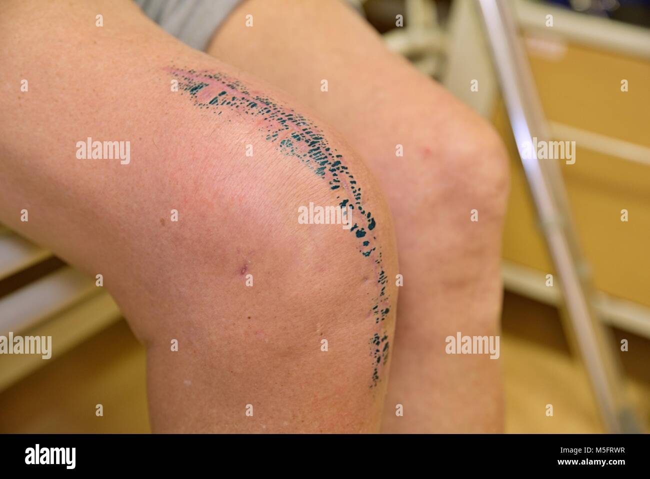 Knee laceration hires stock photography and images Alamy