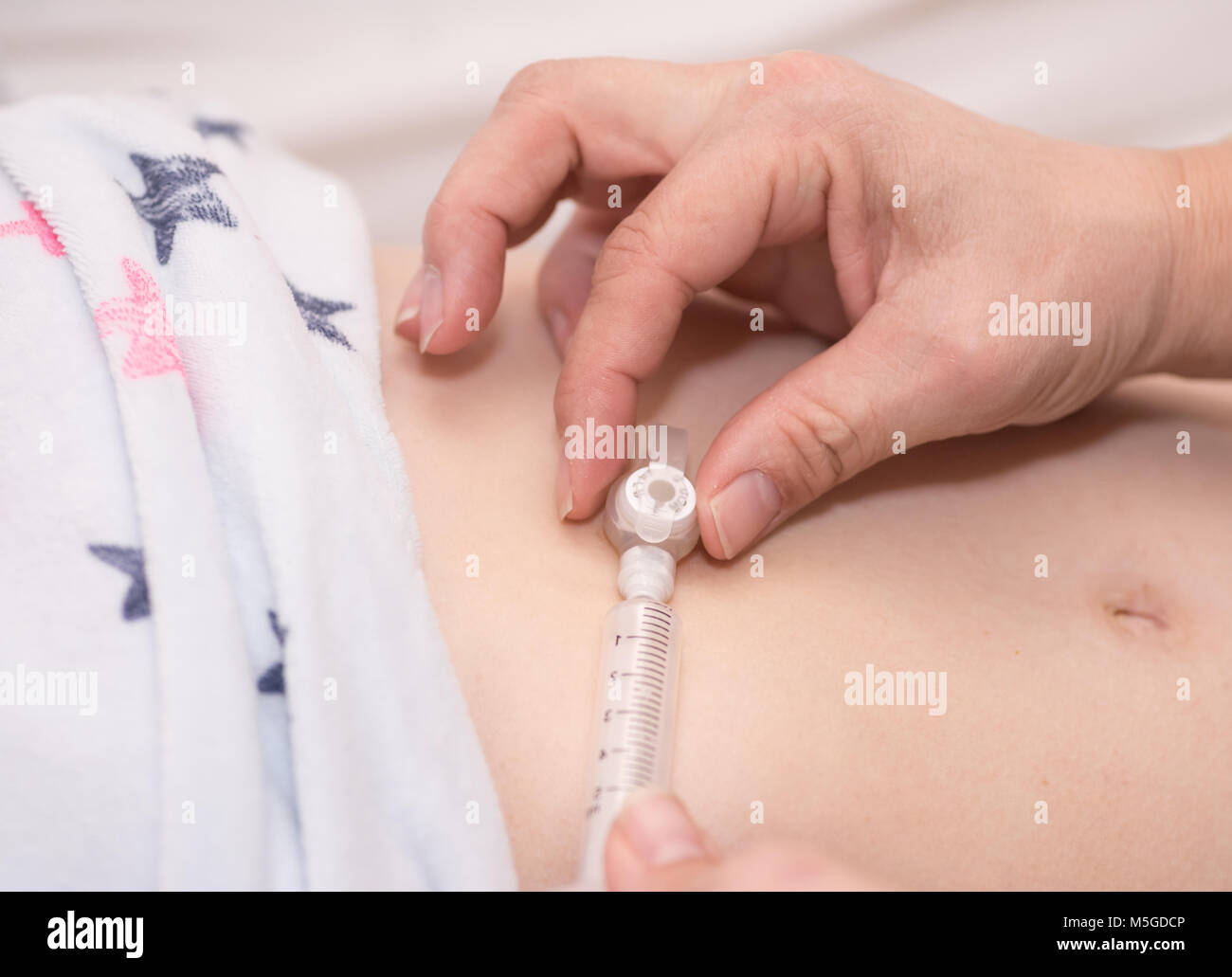 A medical feeding tube being used on a child Stock Photo