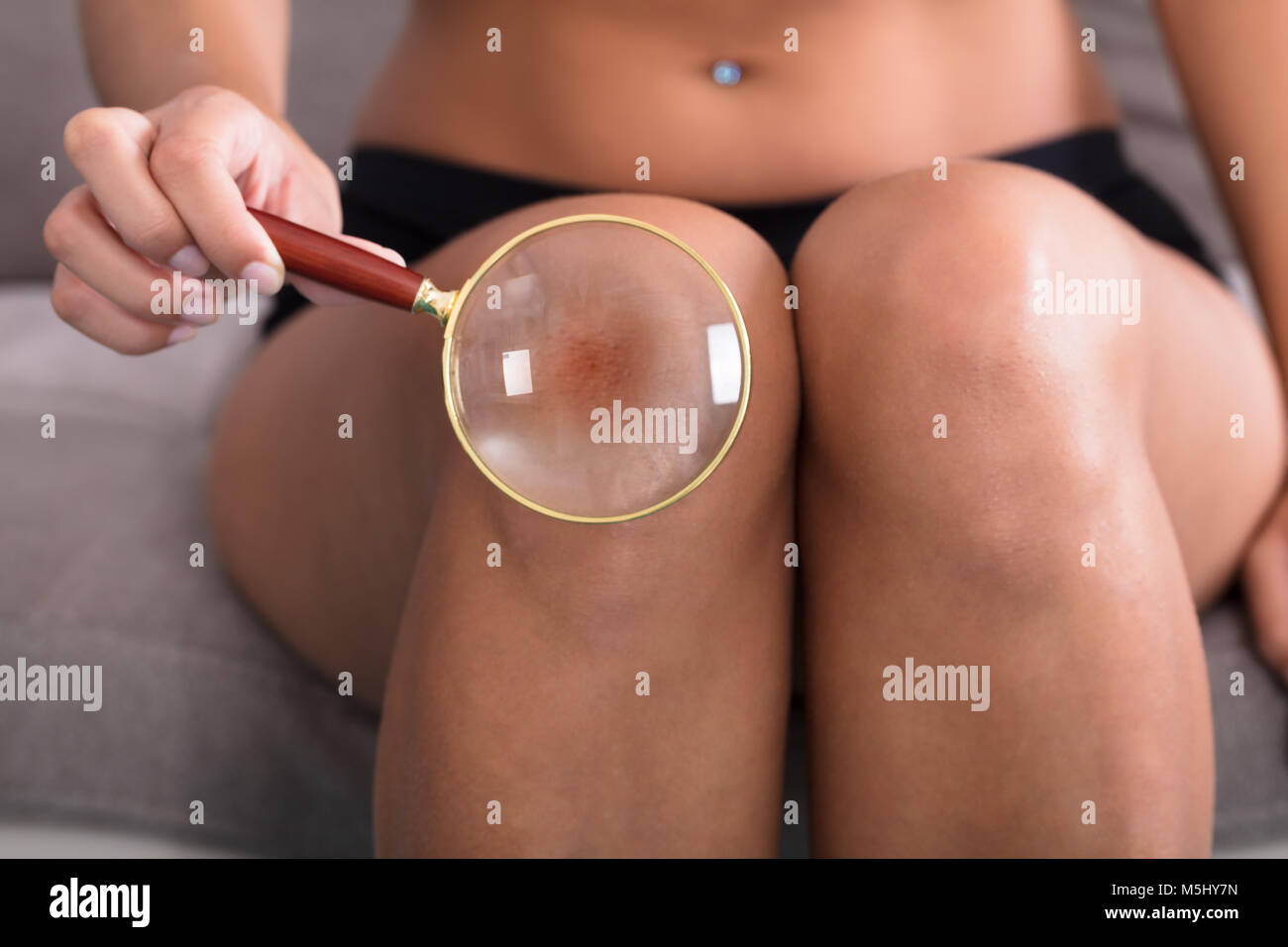 Woman Holding Magnifying Glass Showing Red Scar On Skin Stock Photo