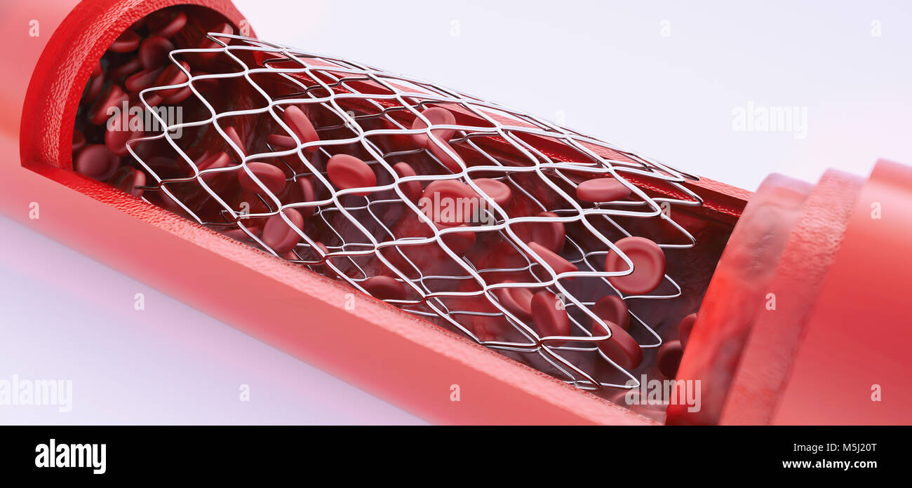 Angioplasty with stent placement --3D rendering Stock Photo