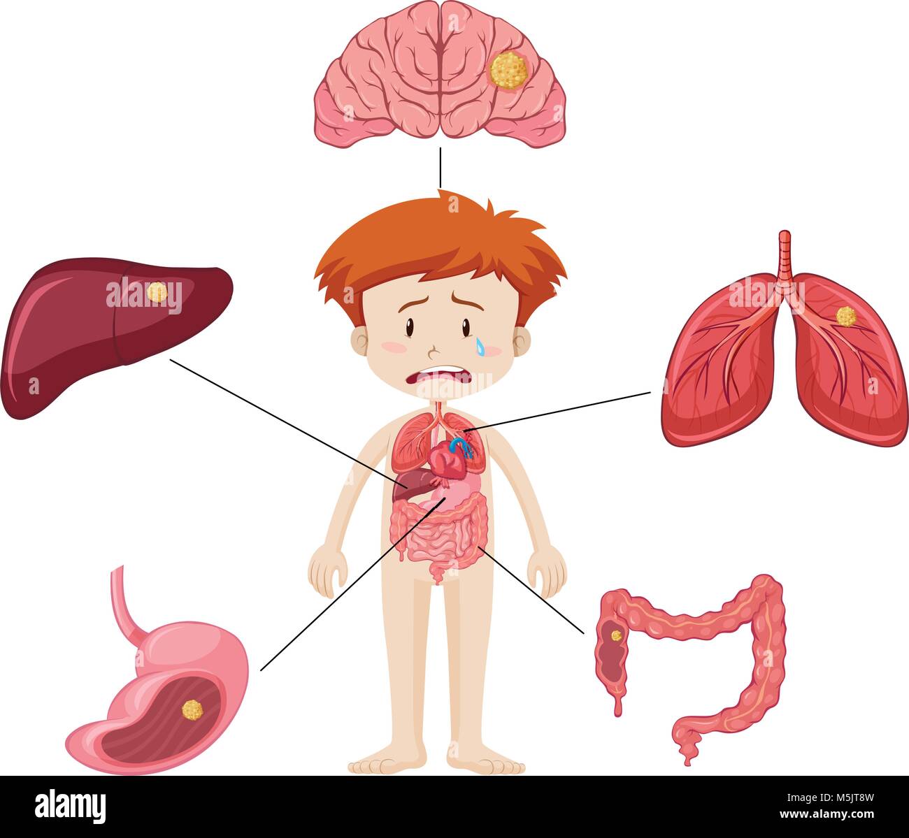 Boy and diagram showing different parts of organs with disease illustration Stock Vector