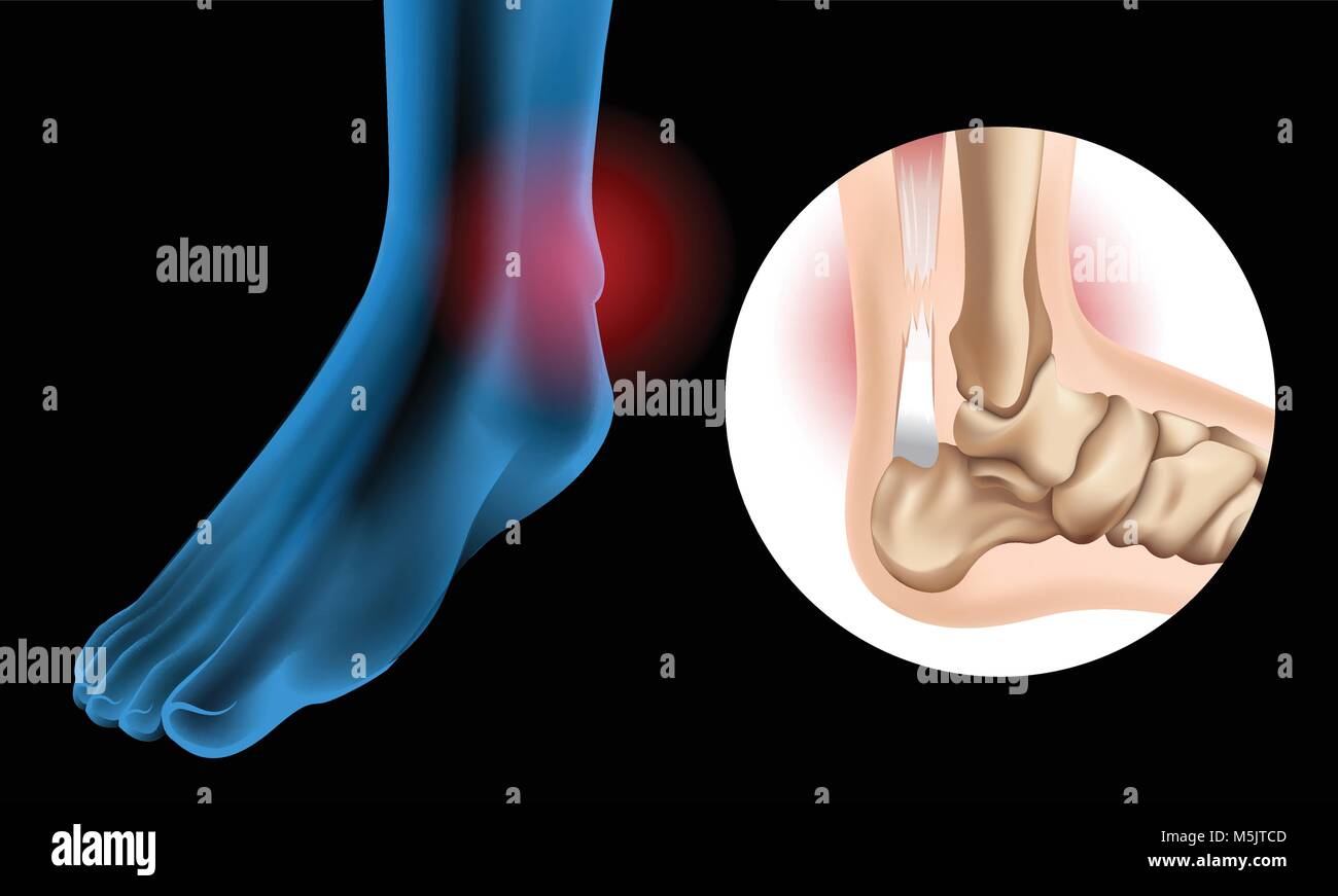 Diagram showing Chronic Achilles tendon tear illustration Stock Vector