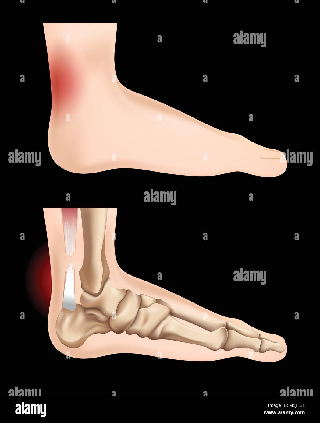 Diagram showing tendon injury illustration Stock Vector