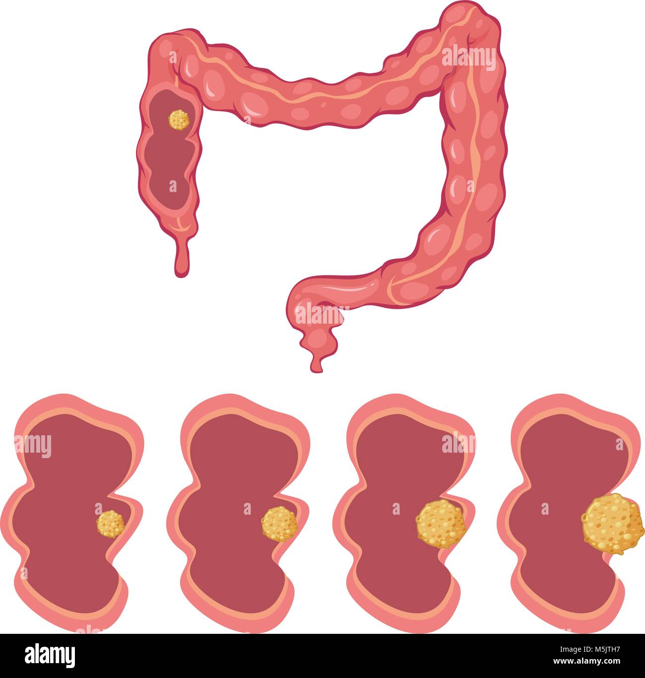 Colon cancer x ray hi-res stock photography and images - Alamy