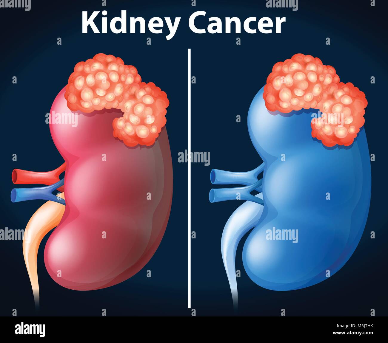 Two diagram of kidney cancer illustration Stock Vector Image & Art Alamy