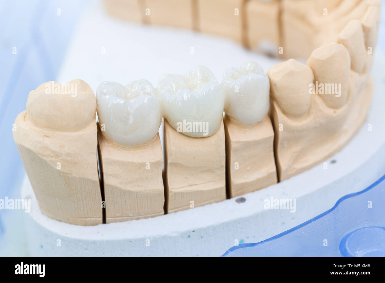 A prosthesis saddle with artificial dentition in a dental laboratory