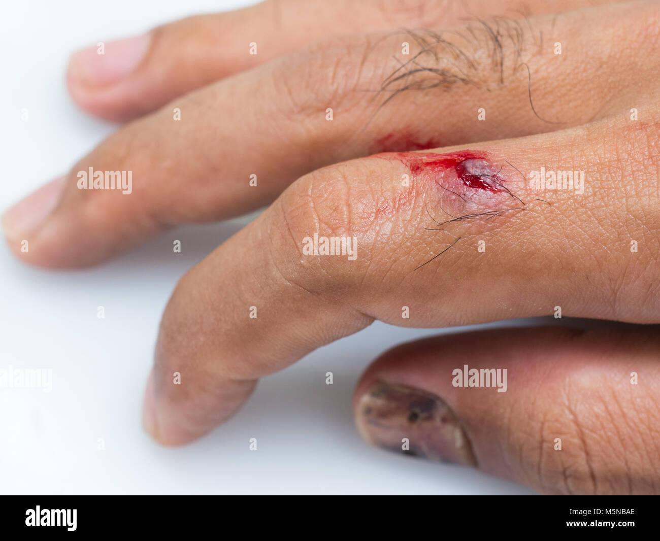 Closeup wound and blood on finger with bruise nail from accident of male hand on white background Stock Photo