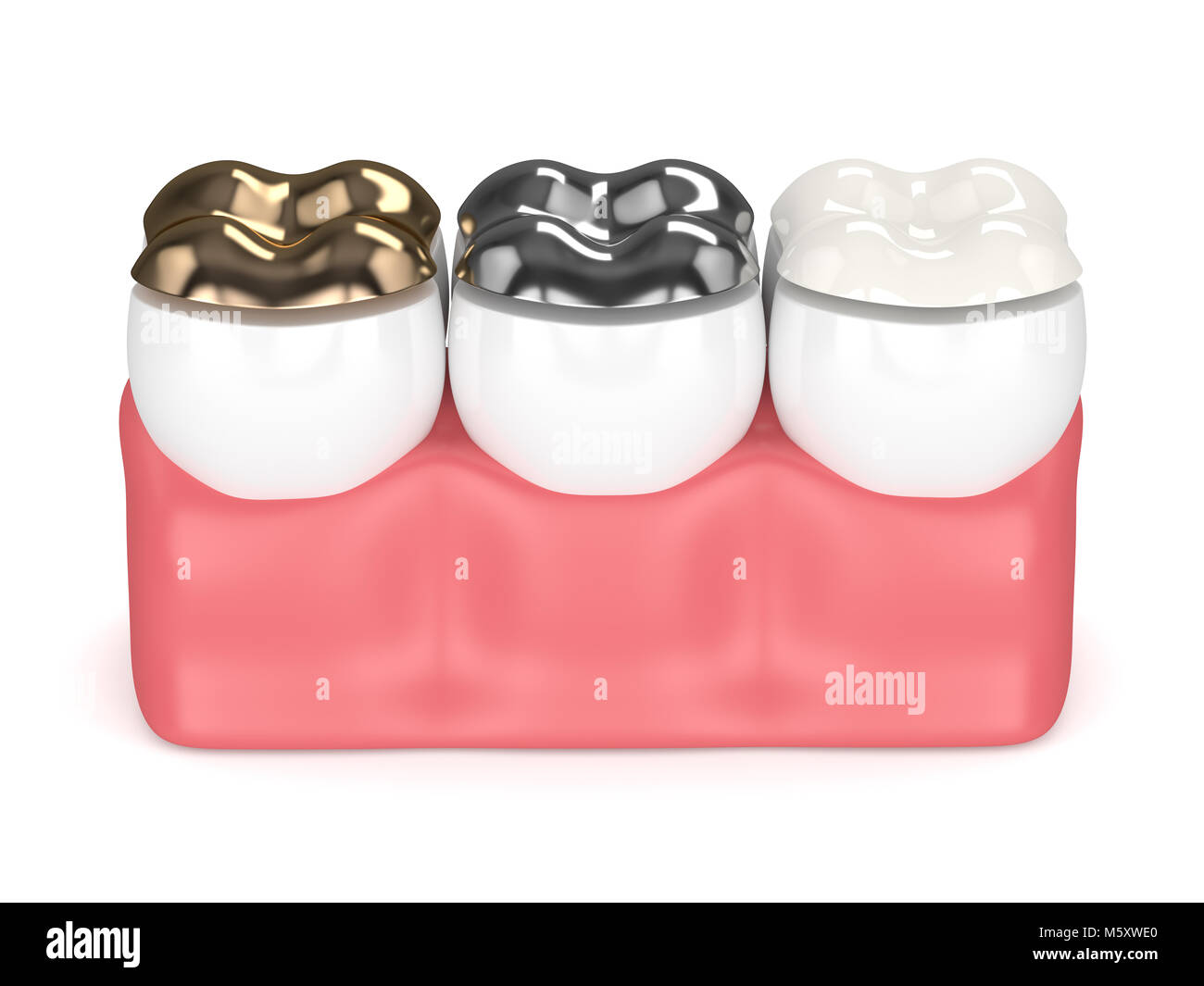 3d render of teeth with gold, amalgam and composite onlay dental