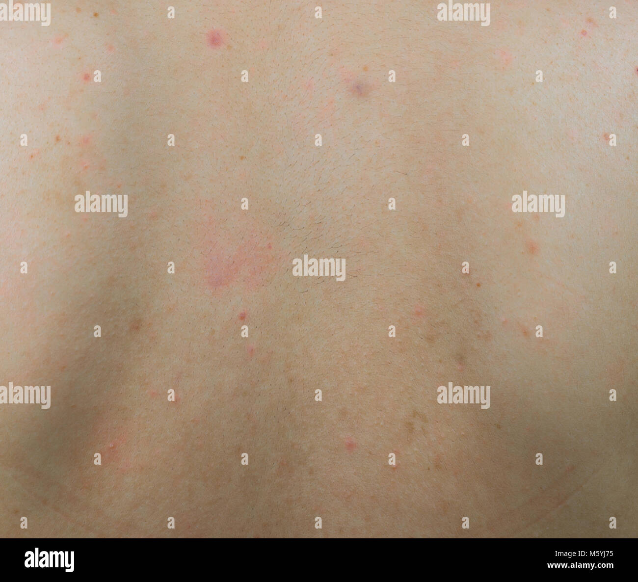 Closeup of acne on back with red spot and dark brown spot on woman back skin. Stock Photo