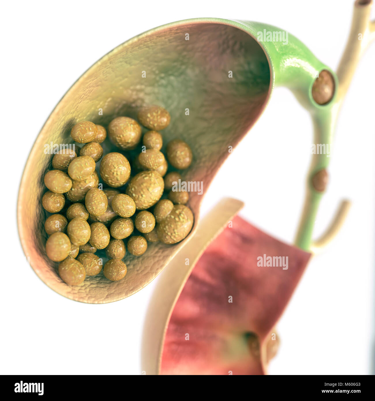 Gallstones in gallbladder and bile duct - high details - 3D rendering Stock Photo