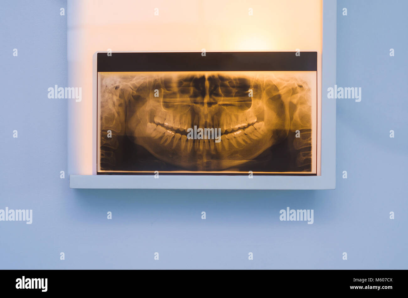 Analyzing dental xray, tooth xray in viewer on the wall Stock Photo
