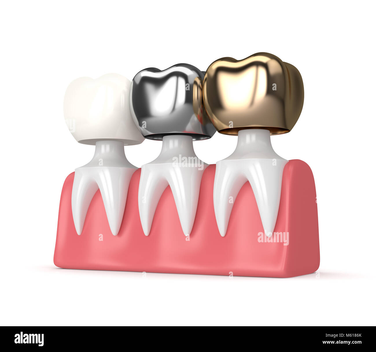3d render of teeth with gold, amalgam and composite dental crown in