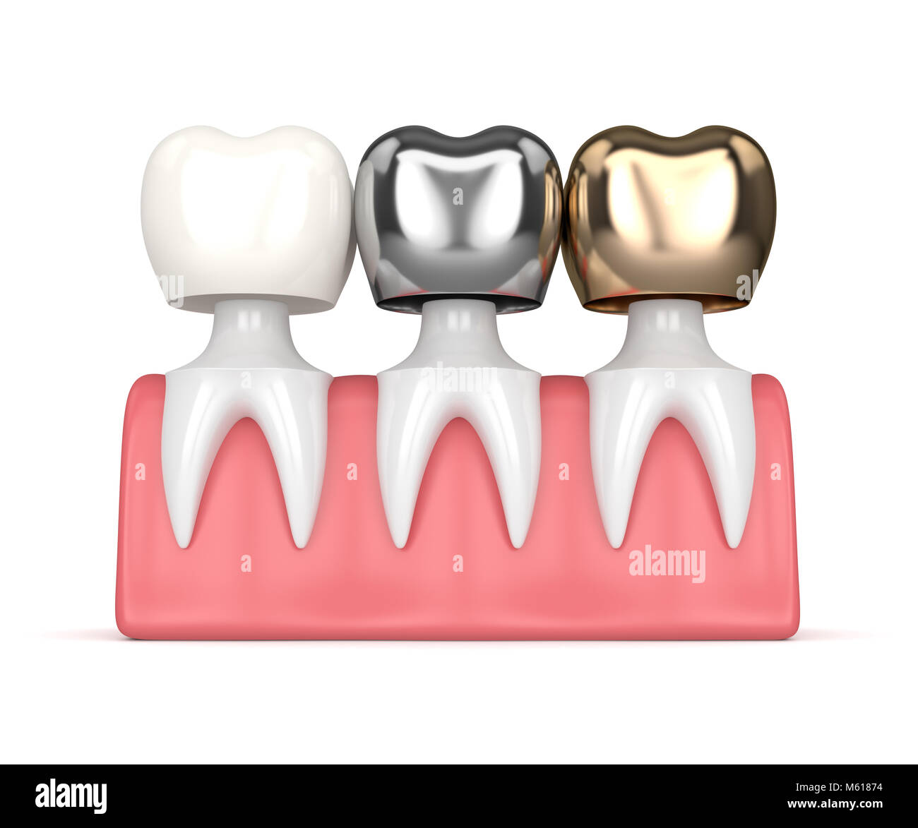 3d render of teeth with gold, amalgam and composite dental crown in