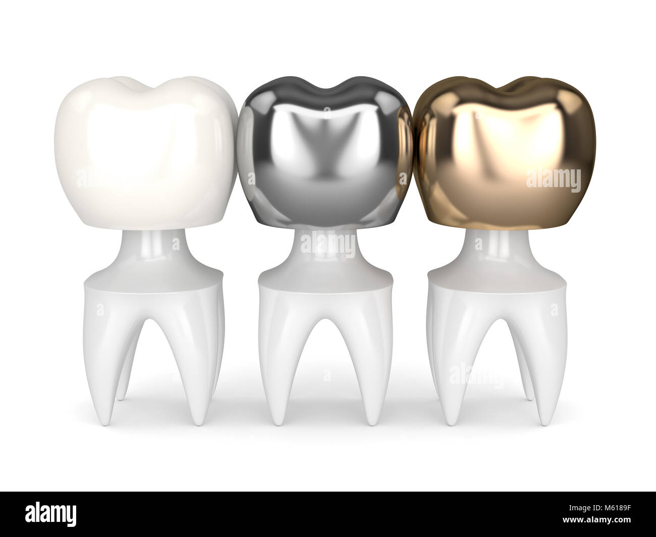 3d render of teeth with gold, amalgam and composite dental crown over