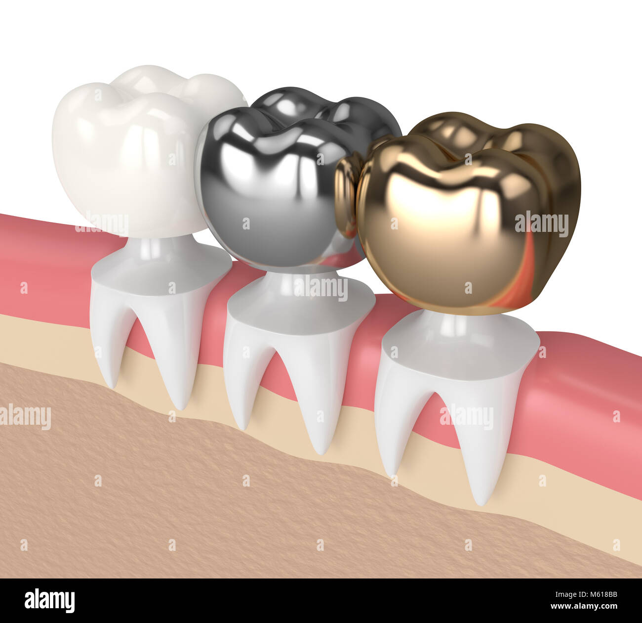 3d render of teeth with gold, amalgam and composite dental crown in
