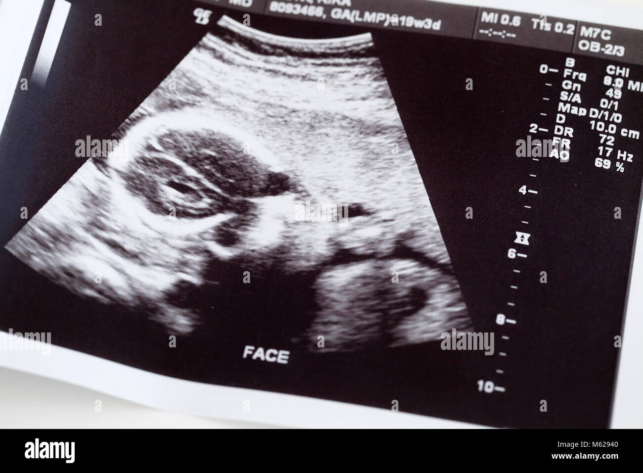 Ultrasound printout of face of fetus in the womb - USA Stock Photo