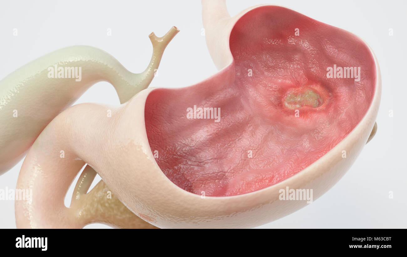 Stomach ulcer - high degree of detail - 3D Rendering Stock Photo